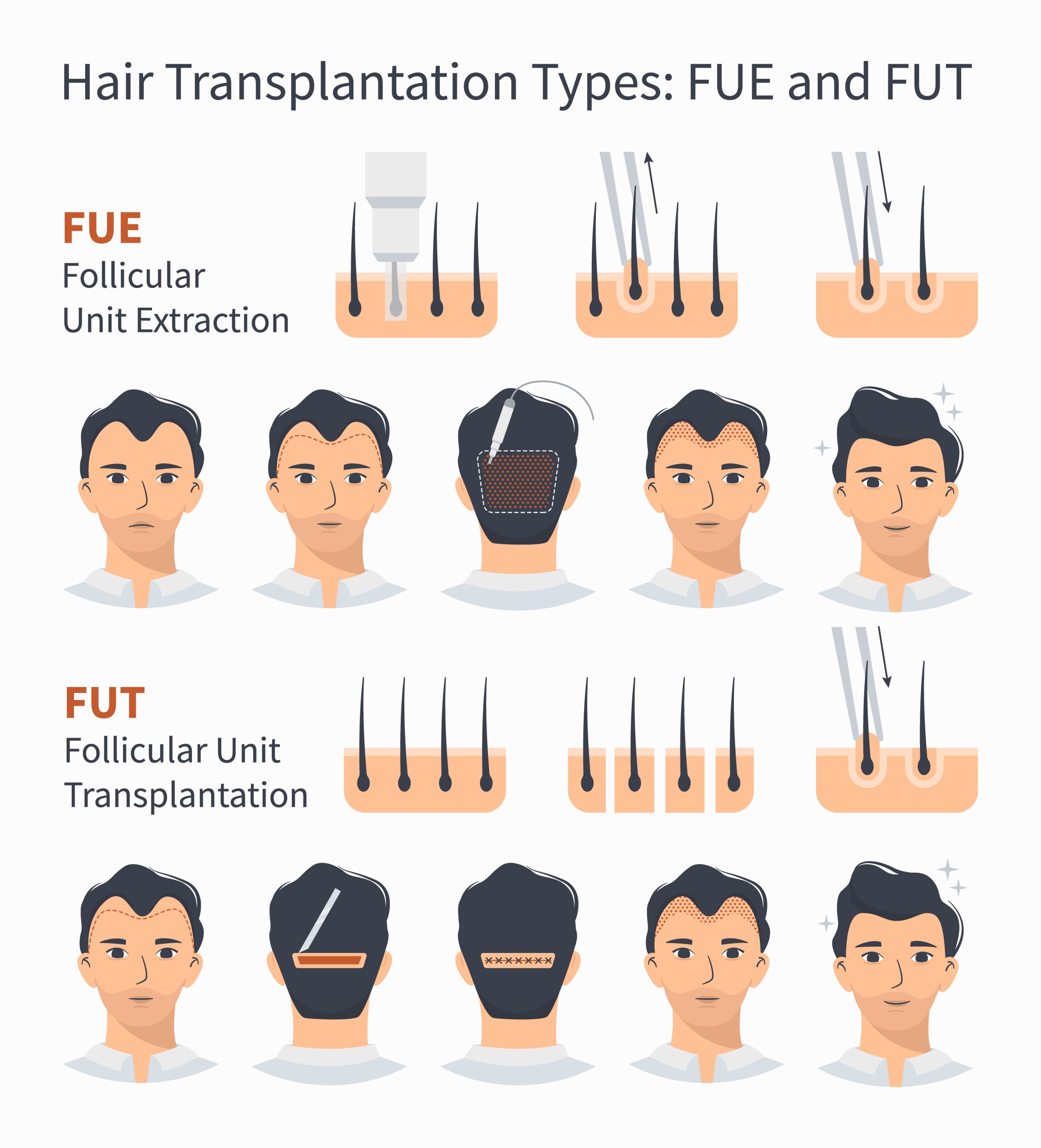 male har transplant