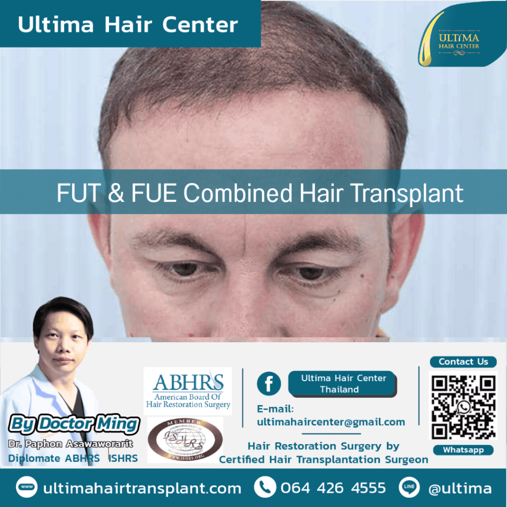 Combined FUT & FUE Hair Transplant
