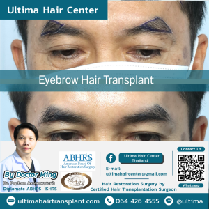 Female Hair Transplant