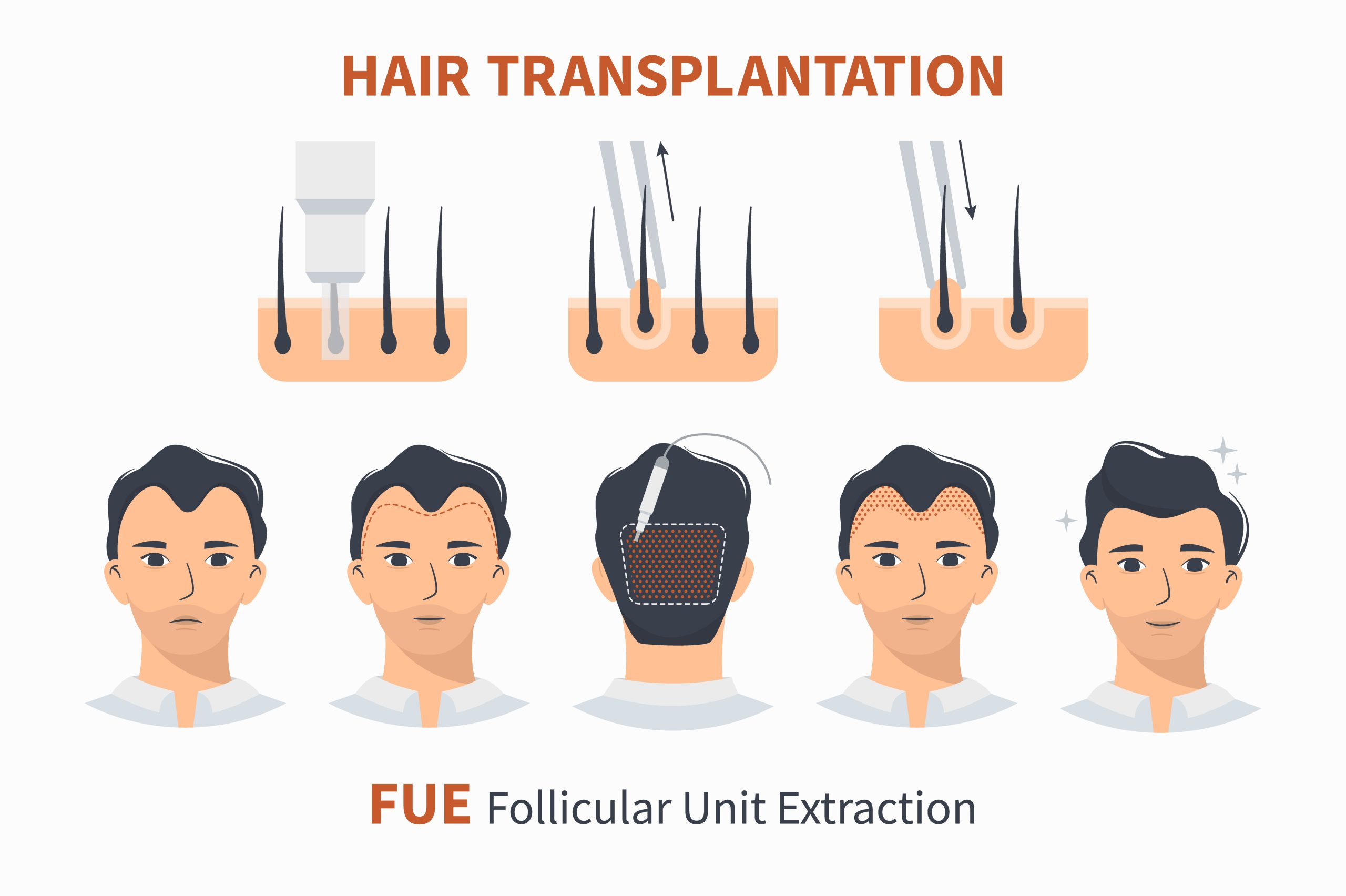 FUE HAIR TRANSPLANT
