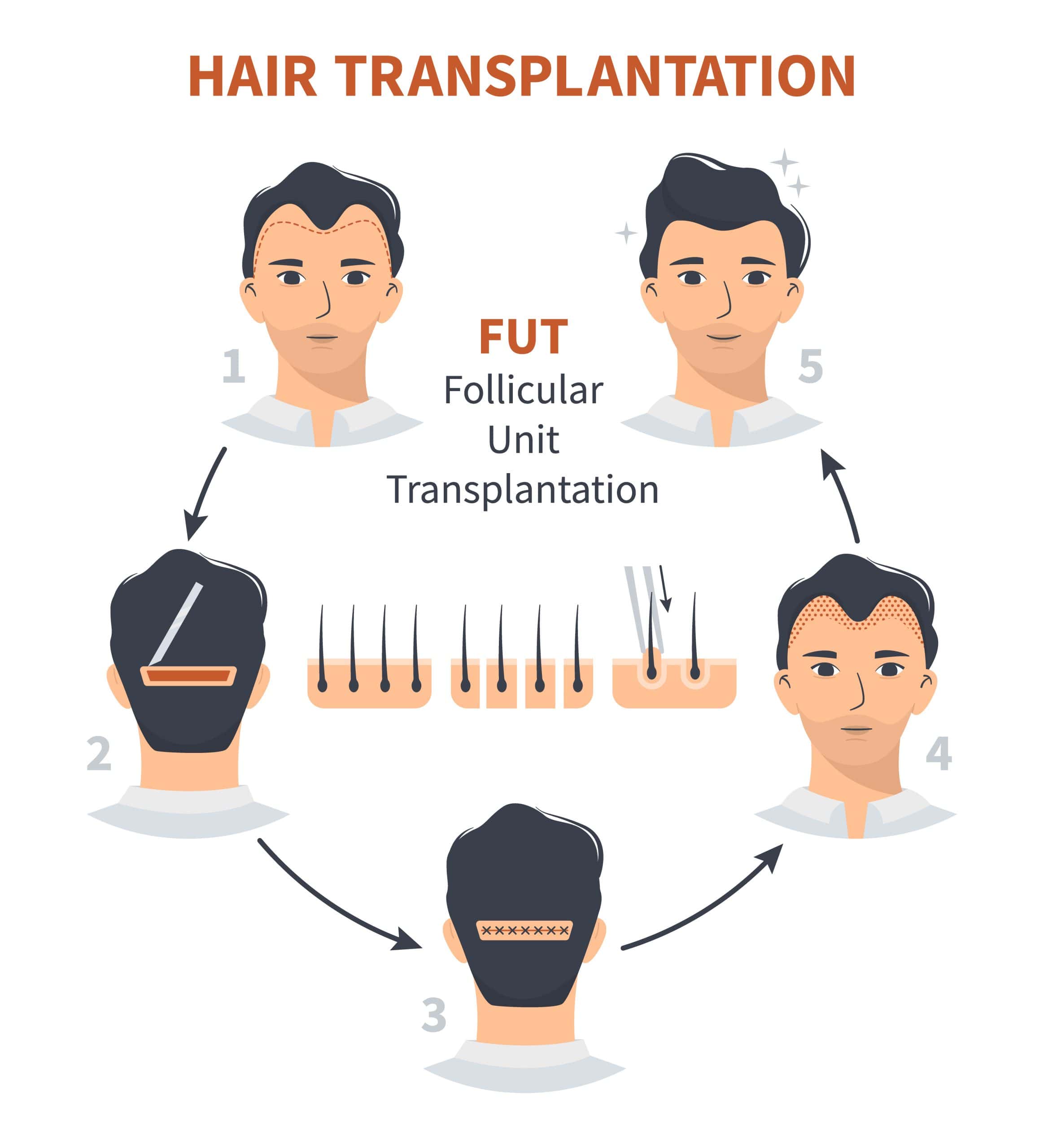 Fut Hair Transplant