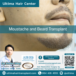 Female Hair Transplant