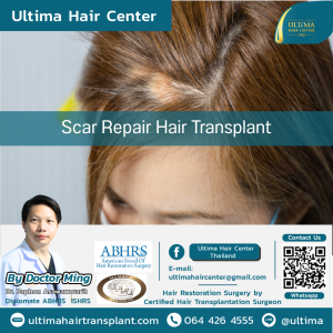 Female Hair Transplant