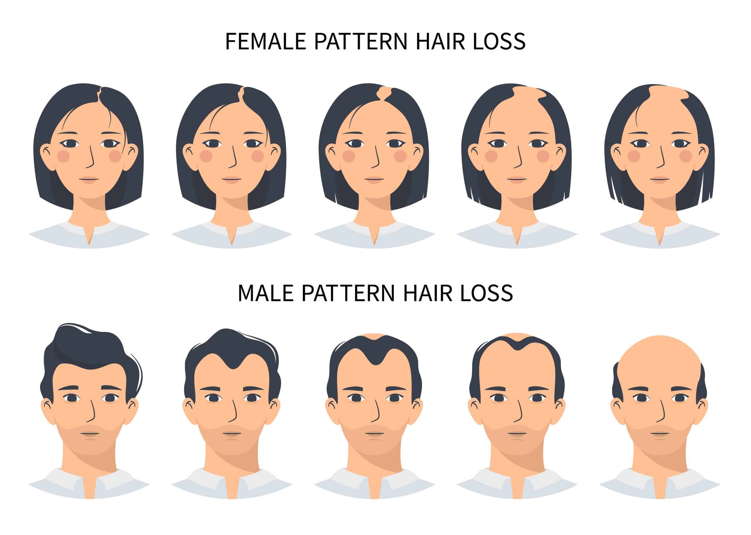 Hair loss stages