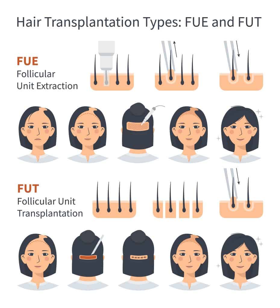Female hair transplantation