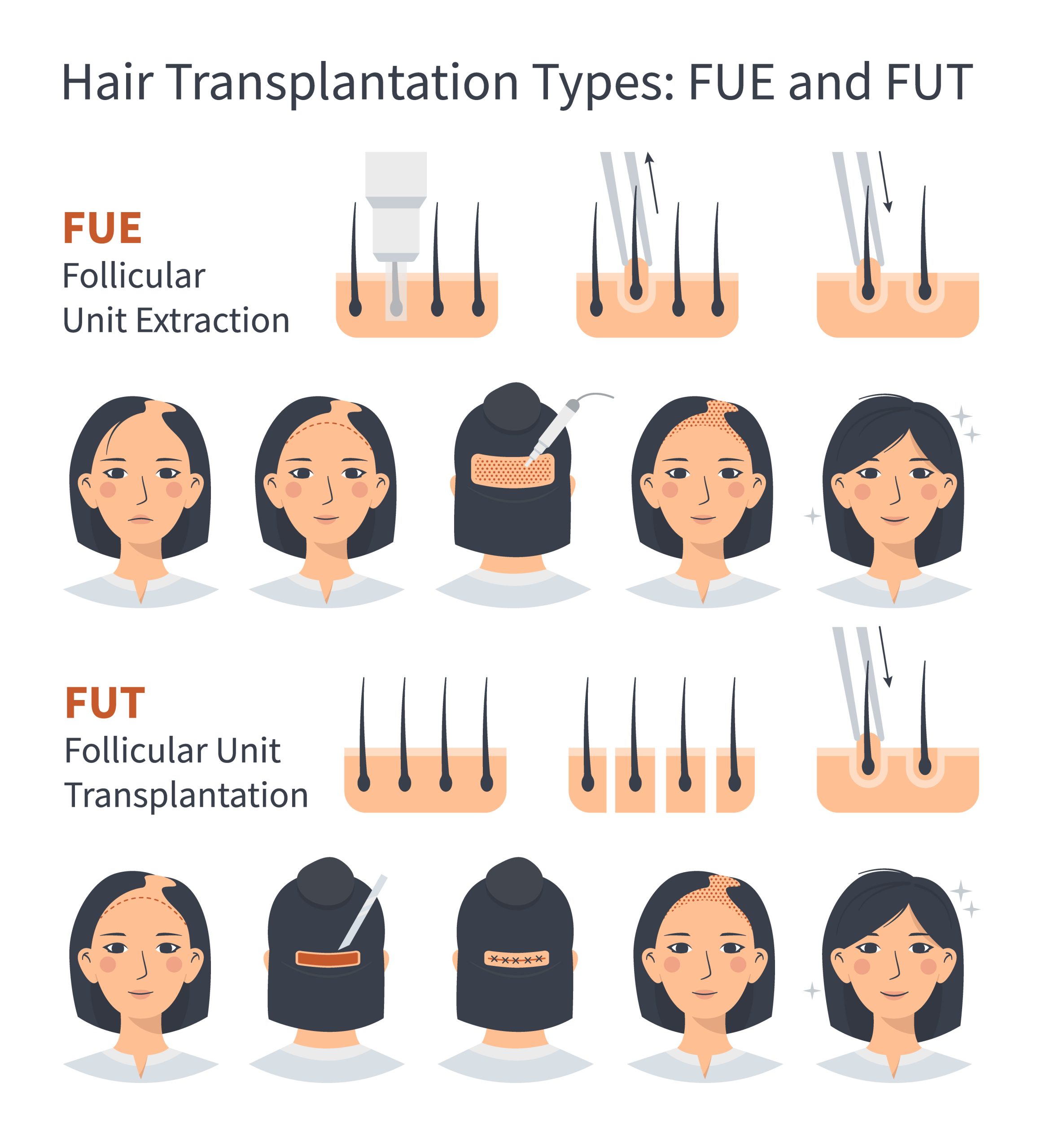Female hair transplantation