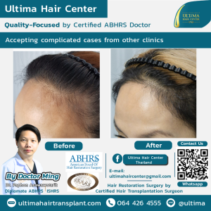 female hair transplant