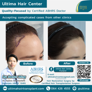 female hair transplant