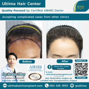female hair transplant