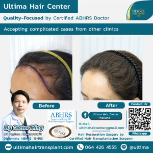 female hair transplant