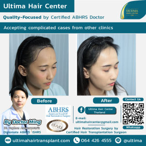 female hair transplant