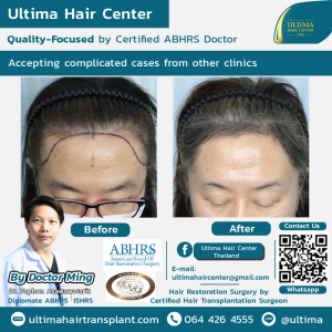 female hair transplant