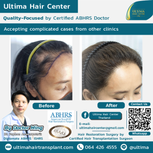 female hair transplant