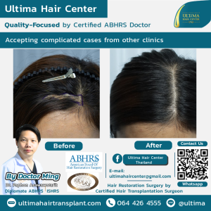 Hair Transplant - Before and After