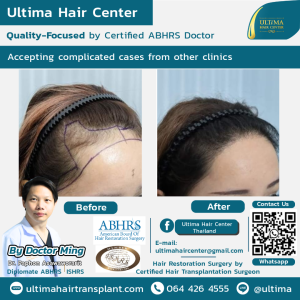 Hair Transplant - Before and After