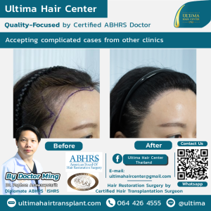 Hair Transplant - Before and After