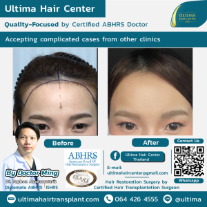 Hair Transplant - Before and After
