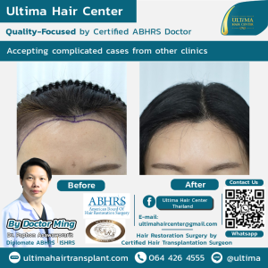 Hair Transplant - Before and After