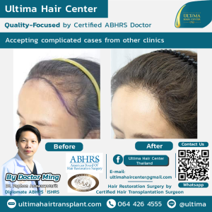 Hair Transplant - Before and After