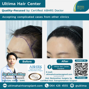 Hair Transplant - Before and After