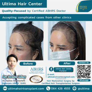 Hair Transplant - Before and After