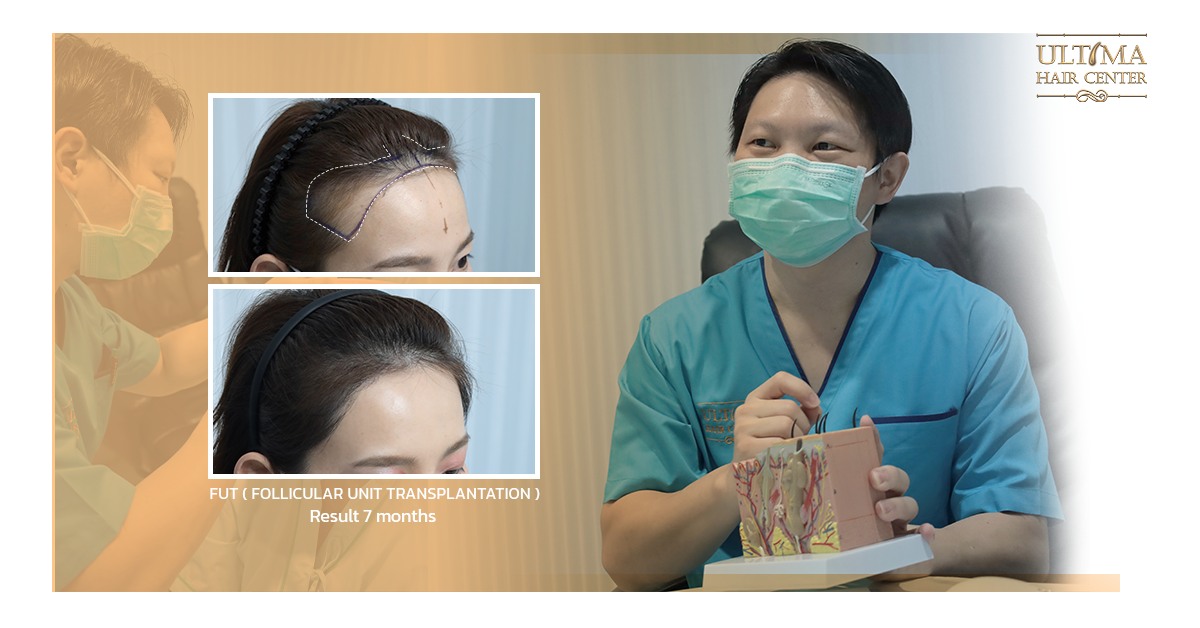 thai hair transplant