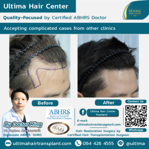 Hair Transplant - Before and After