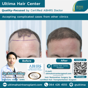 Hair Transplant - Before and After