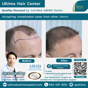 Hair Transplant - Before and After