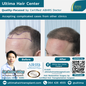 Hair Transplant - Before and After