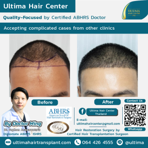 Hair Transplant - Before and After