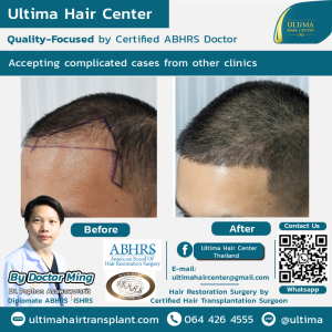 Hair Transplant - Before and After
