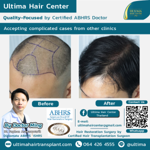 Hair Transplant - Before and After