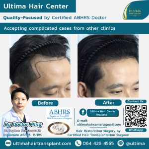 Hair Transplant - Before and After
