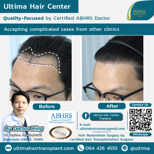 Hair Transplant - Before and After