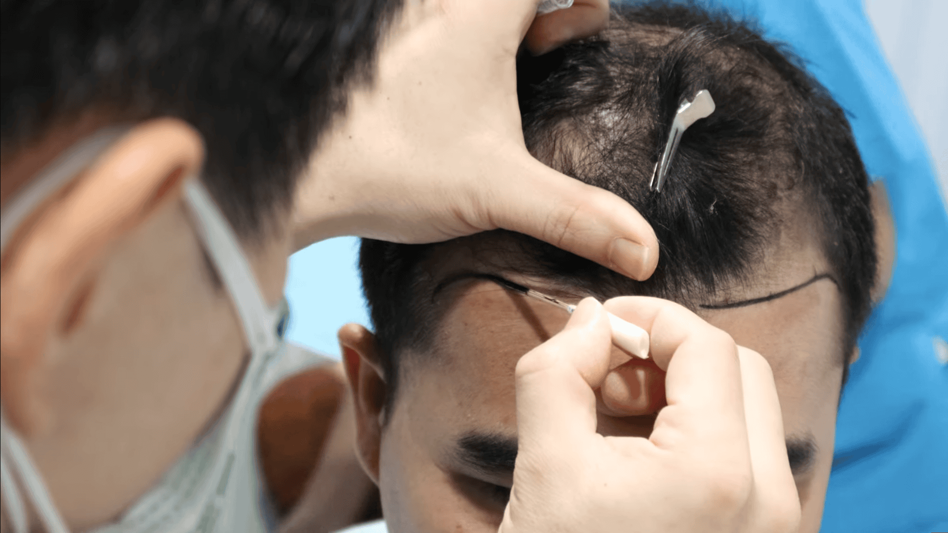 Transgender Hair Transplant