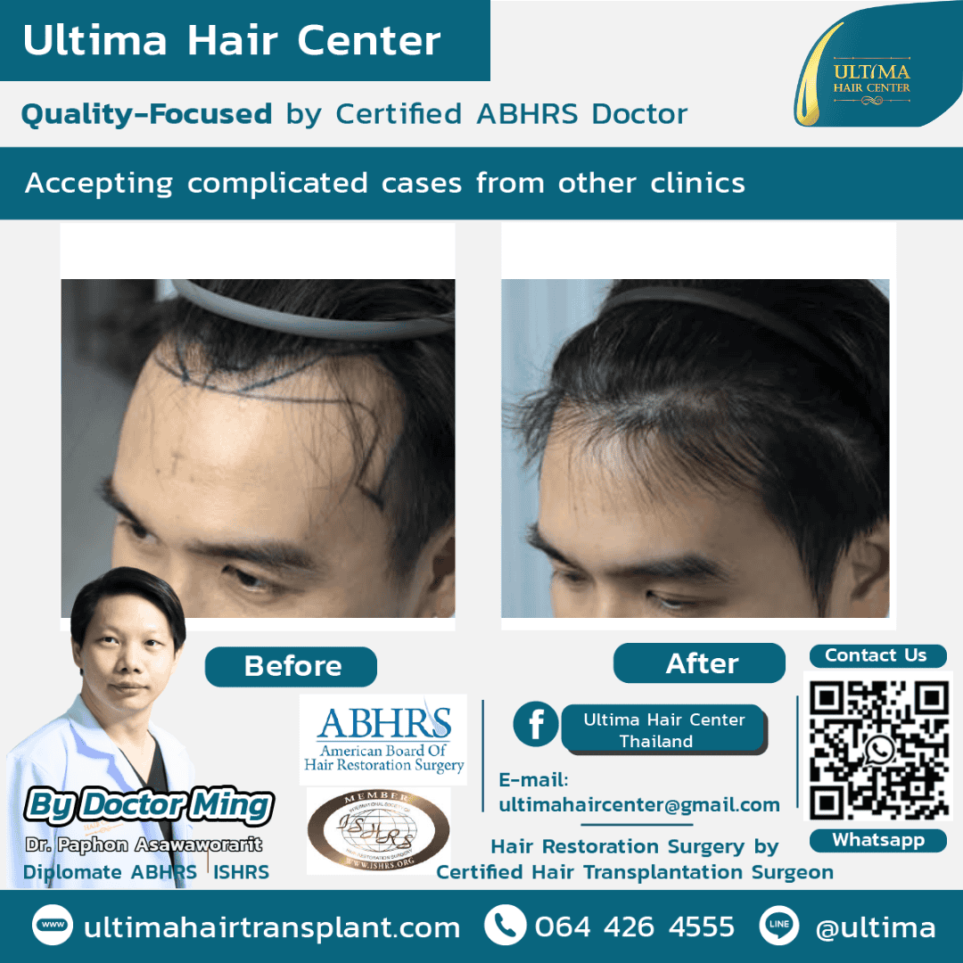 Hair transplant Thailand Bangkok