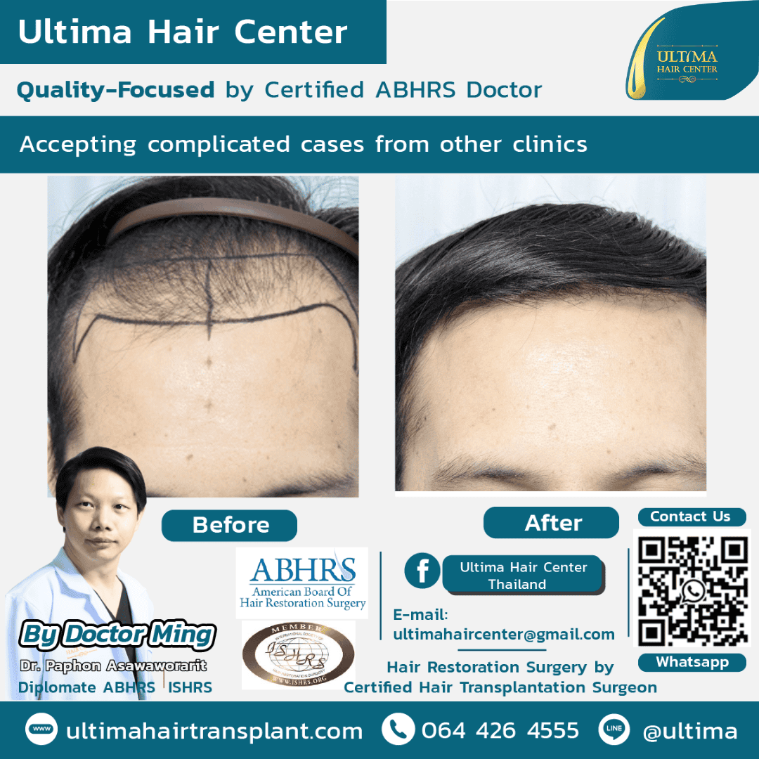 Hair transplant Thailand Bangkok