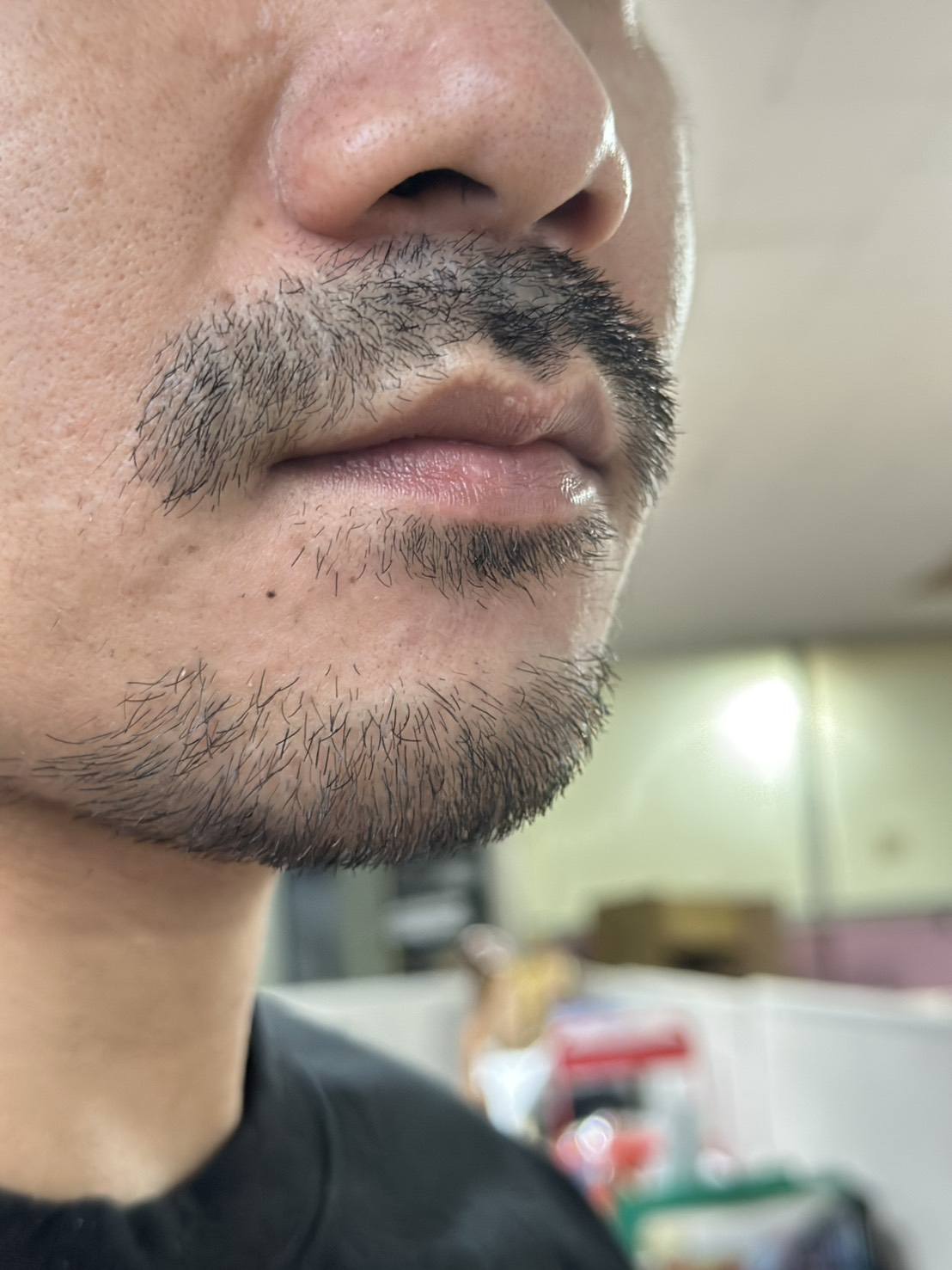 beard transplant