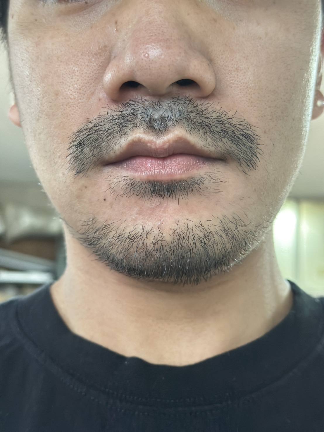 beard transplant