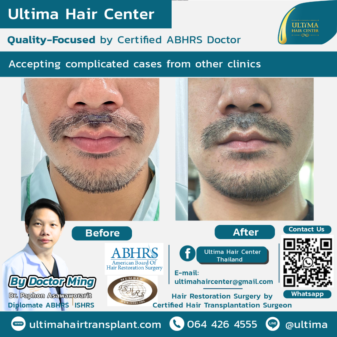 beard transplant