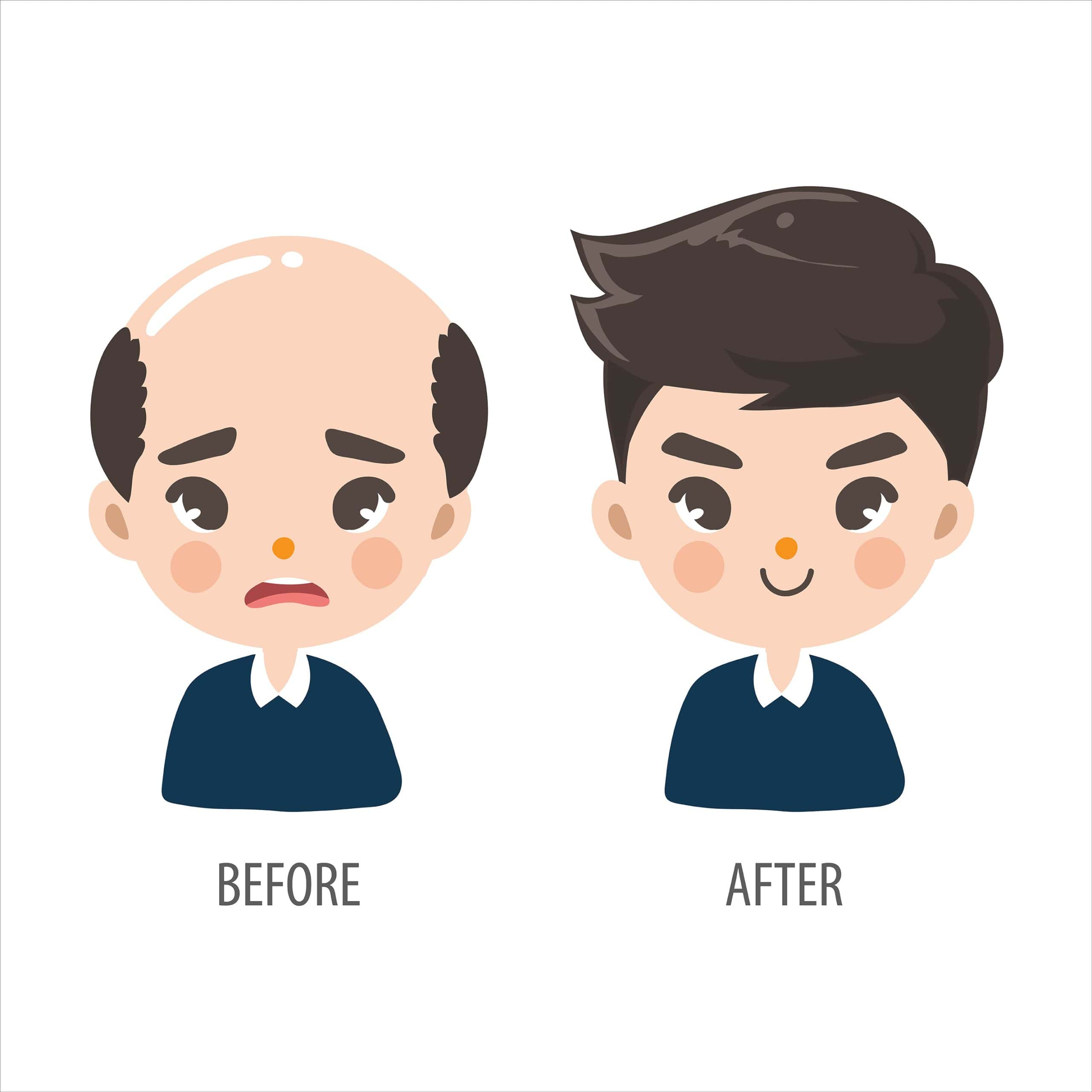 Hair Transplant Thailand
