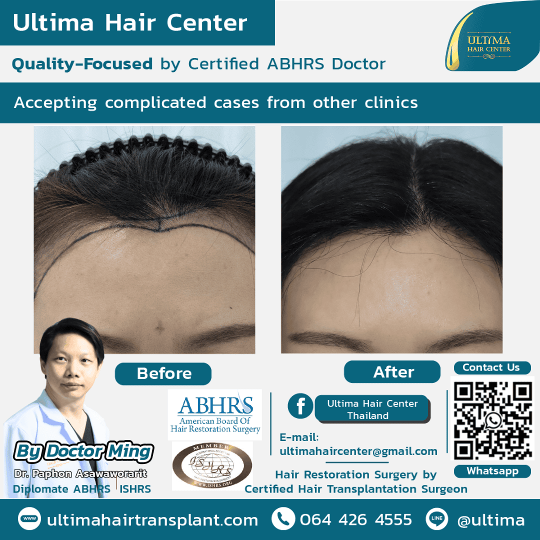Hair restoration surgery