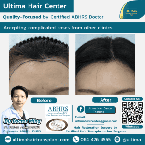Women's Hair Transplant Before After Pictures