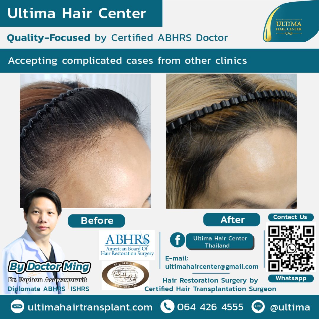 Is Thailand good for hair transplants