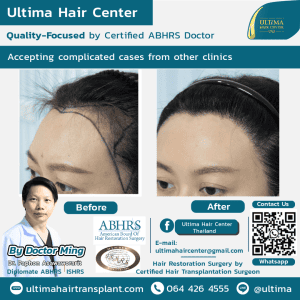 What if I need more grafts than initially estimated