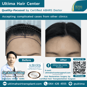 Women's Hair Transplant Before After Pictures