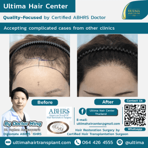 What if I need more grafts than initially estimated