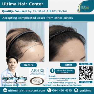 Why is hair transplant in Thailand often more affordable