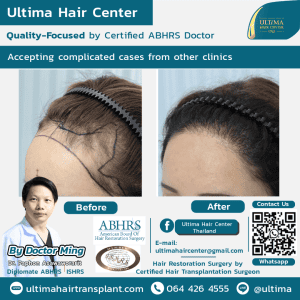 What if I need more grafts than initially estimated